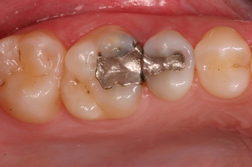 Before Inlays & Onlays